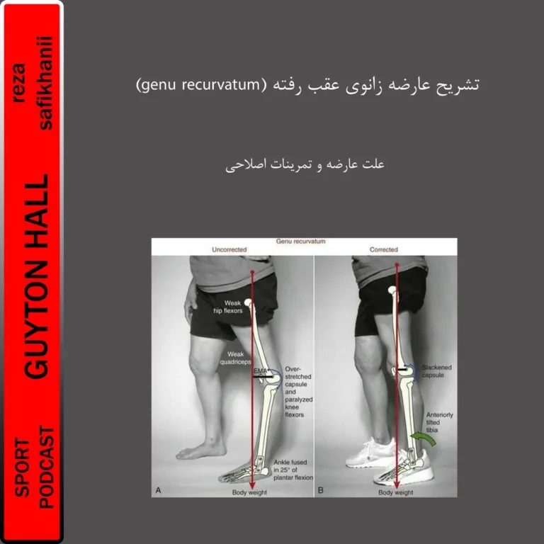 تشریح عارضه زانوی عقب رفته (Genu Recurvatum)